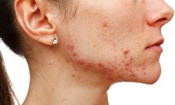 El Adolescente y el Mangostán. II. El Mangostán, controla el acné, por su efecto antioxidante y antiinflamatorio.