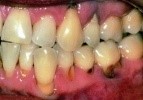El Adulto Mayor y el Mangostán. VIII. Problemas en la dentadura, se controla con el Mangostán.