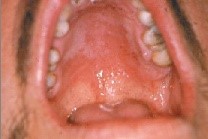El Adulto Mayor y el Mangostán. VIII. Ulceras aftosas en el paladar.