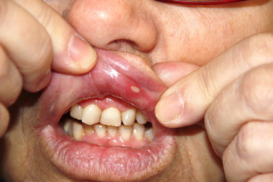 Lesiones en la boca se controlan tomando el jugo del Mangostán.