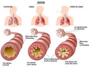 El Asma es una enfermedad pulmonar obstructiva.