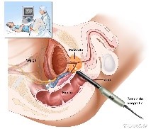 El Cáncer II. En el hombre realizar el tacto rectal y el antígeno prostático, cada año, para prevenir el Cáncer de Próstata.