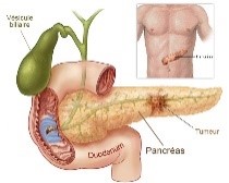 El Cáncer del Páncreas causa estragos en el paciente que lo presenta.