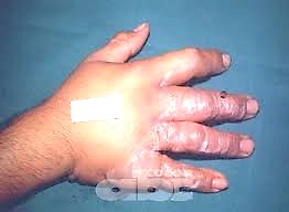 Lesión de los dedos por aplastamiento.