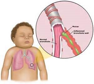 Problemas Respiratorios. IV. Cualquier grado de obstrucción, reduce el área respiratoria. 