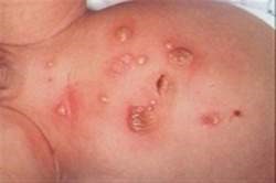 Cuando un área del eczema se rasca se contagia y puede provocar un impétigo.