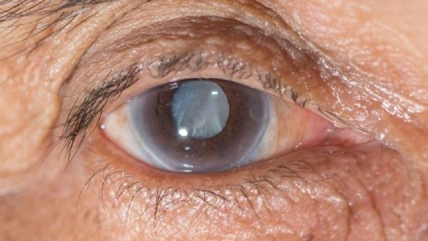 El Glaucoma, se caracteriza por pérdida progresiva de las porciones periféricas de la visión.