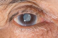 El Glaucoma, se caracteriza por pérdida progresiva de las porciones periféricas de la visión.