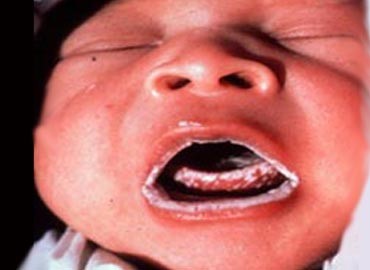 El algodoncillo se encuentra en los bebés, no se le considera infeccioso.