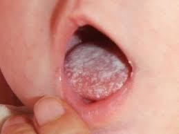 El algodoncillo se encuentra en los bebés y casi no es contagioso.