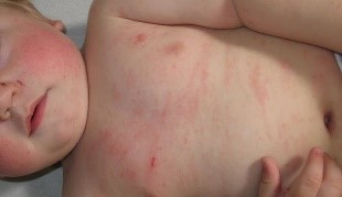 El contacto íntimo de niños con escabiasis, puede ocasionar la infección a otros.
