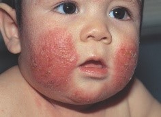 El eczema es un problema de la piel que no es contagioso.