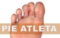 El pie de atleta es una infección por hongos en la planta de los dedos del pie.