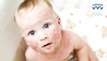El tratamiento para el eczema es muy variado y muy resolutivo.
