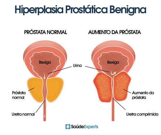 La Hipertrofia Prostática puede provocar Incontinencia Urinaria.