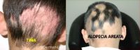 La diferencia entre tiña y alopecia areata.