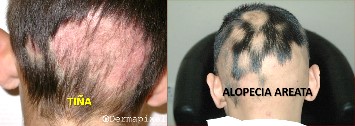 La diferencia entre tiña y alopecia areata. 