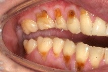 Los dientes se pueden maltratar por bulimia.