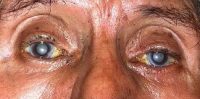 Ojos con Cataratas
