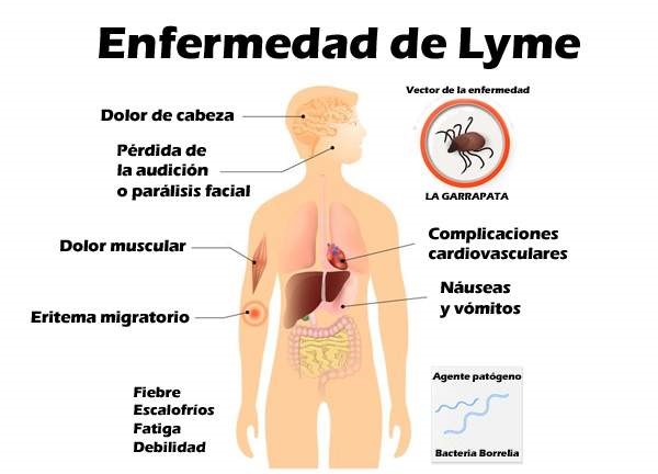 Síntomas y signos característicos de la Enfermedad de Lyme.