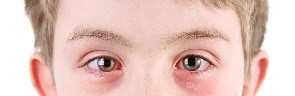 Algunas veces pueden surgir problemas alérgicos los que provocan irritación a los ojos.