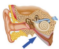 La obstrucción de la trompa de Eustaquio causa infección de los oídos.