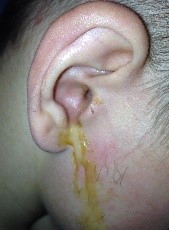 Las secreción de oídos, se tendrían que ver en algunos casos como algo normal.